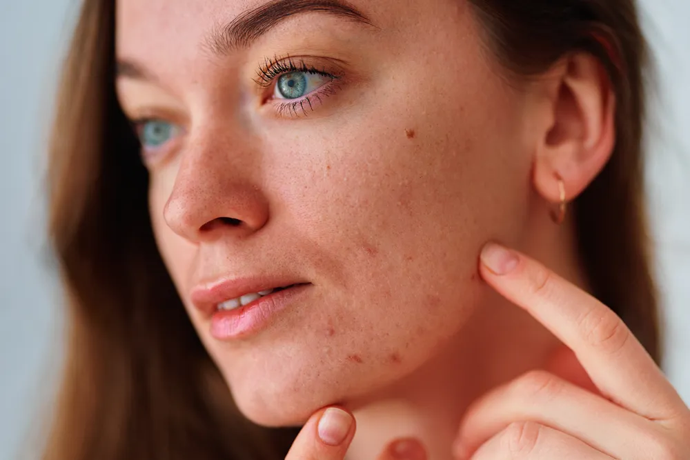 Dry Skin
