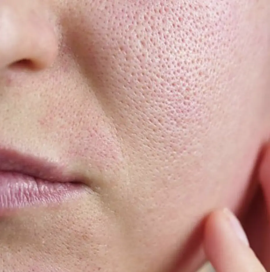 Pores